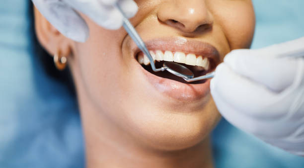 Best Emergency Wisdom Teeth Removal in Morada, CA